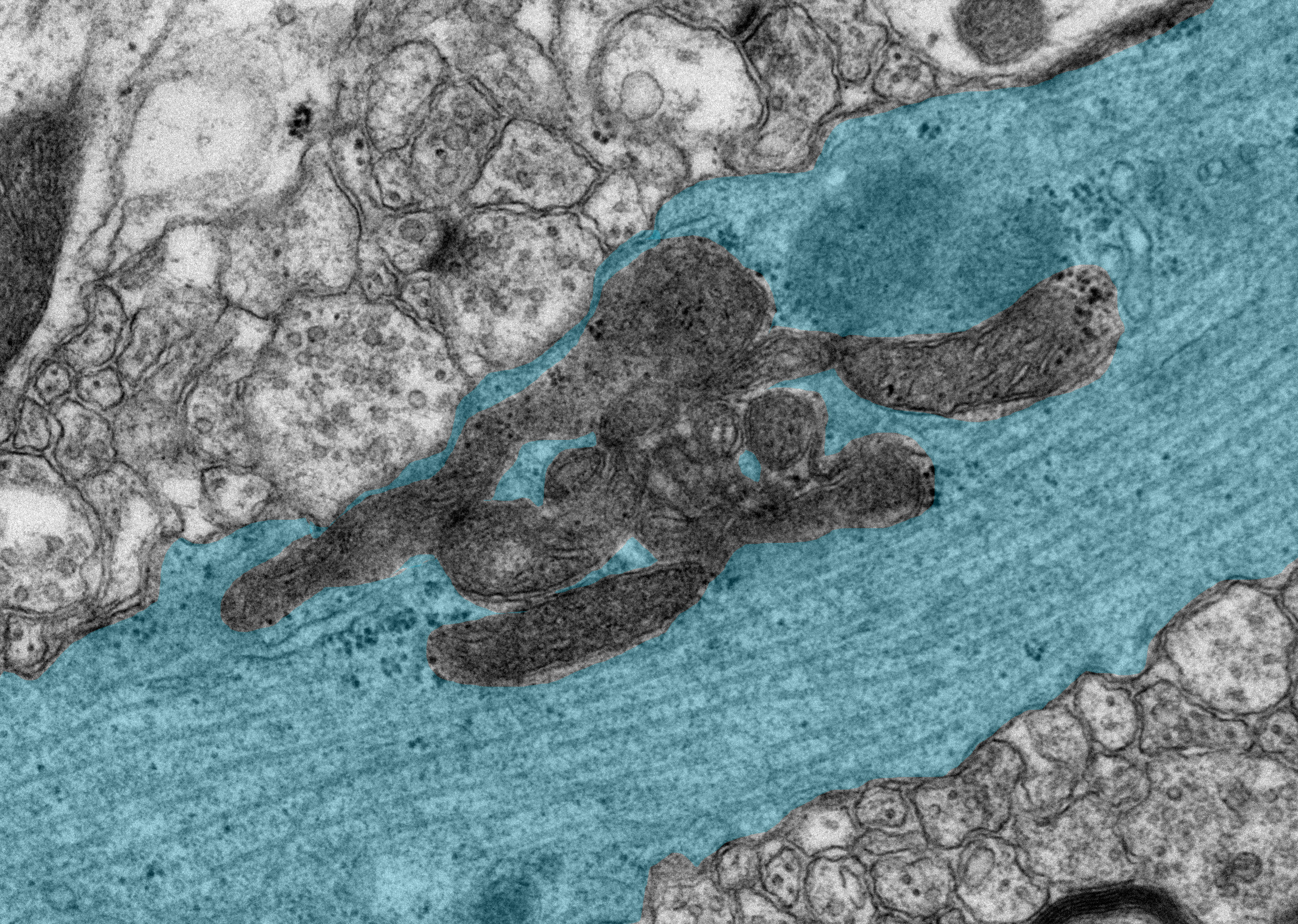 ミトコンドリアの融合因子を機能不全にしたマウスの脳の電子顕微鏡写真。青く塗った部分はニューロンの軸索の縦断面で、軸索上にミトコンドリアが凝集して分布していることがわかります。
